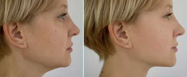 Rugas Cara Mulher Antes Depois Tratamento Dobro Queixo — Fotografia de Stock