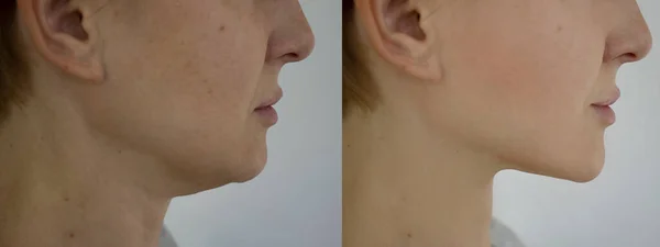 Γυναίκα Πρόσωπο Ρυτίδες Πριν Και Μετά Από Διπλή Θεραπεία Πηγούνι — Φωτογραφία Αρχείου