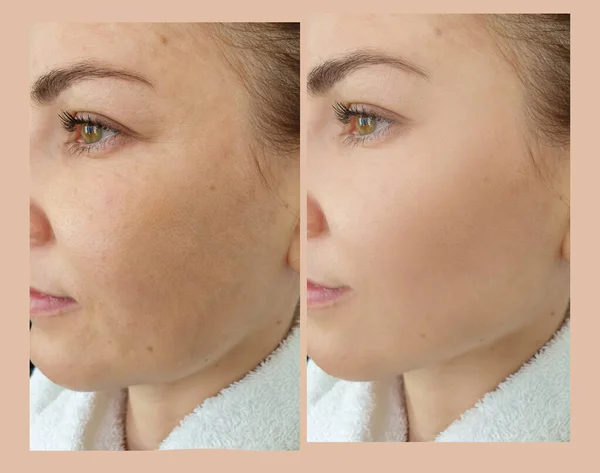 Woman face wrinkle before and after treatment, double chin
