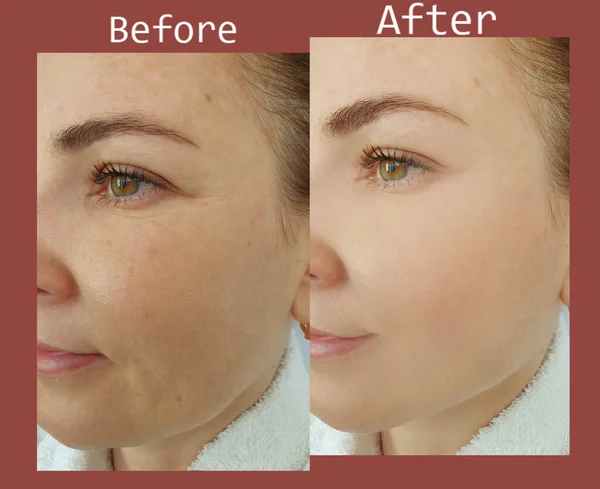 Woman Face Wrinkle Treatment Double Chin — Photo