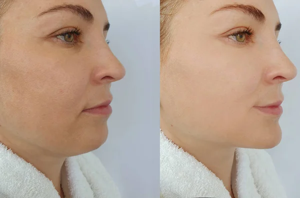 Woman Face Wrinkle Treatment Double Chin — 스톡 사진