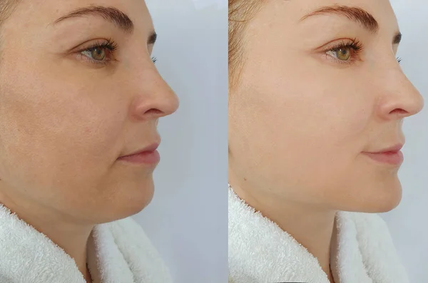 Woman Face Wrinkle Treatment Double Chin — Zdjęcie stockowe