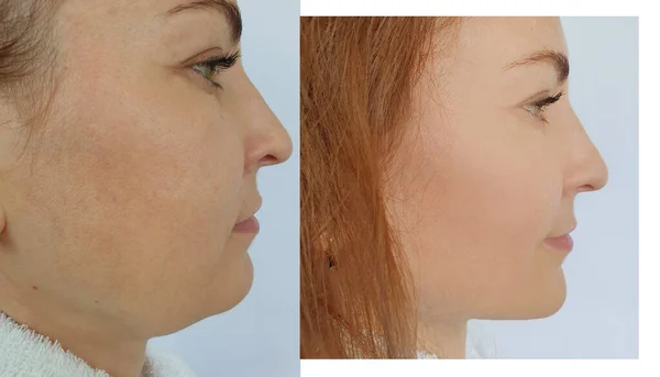 Woman Face Wrinkle Treatment Double Chin — Stok Foto