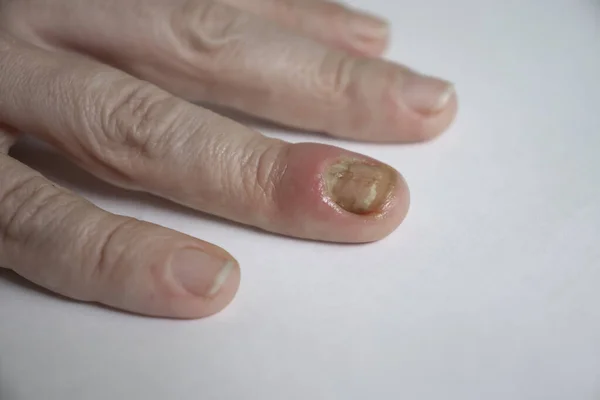 Paronychia Disease Fingernail – stockfoto