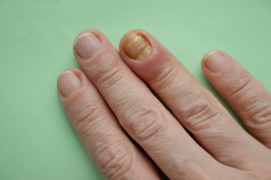 Paronychia disease of the fingernail