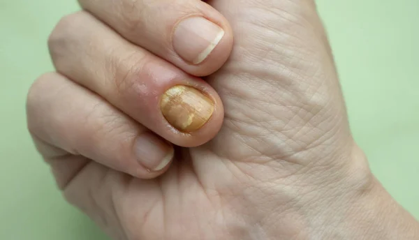 Paronychia Disease Fingernail — Foto de Stock