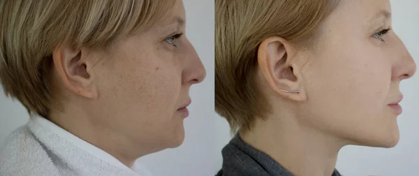 Woman Double Chin Treatment — Stock Photo, Image