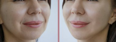 Kadın tedaviden önce ve sonra çift çene