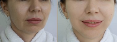 Kadın tedaviden önce ve sonra çift çene