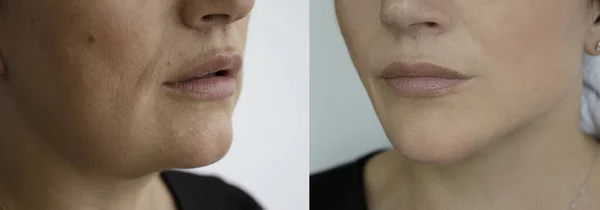 Woman double chin before and after treatment