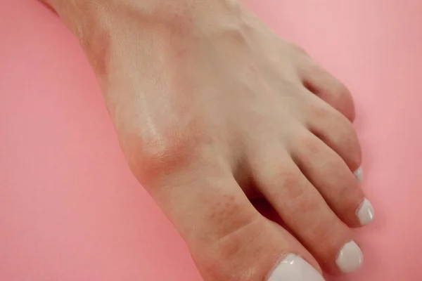 Hallux valgus, bunion on female foot over pink background. Medical concept