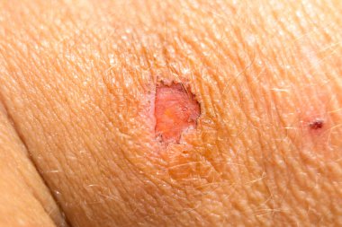 Extreme close up of a healing soft tissue wound with surrounding trauma on a persons arm
