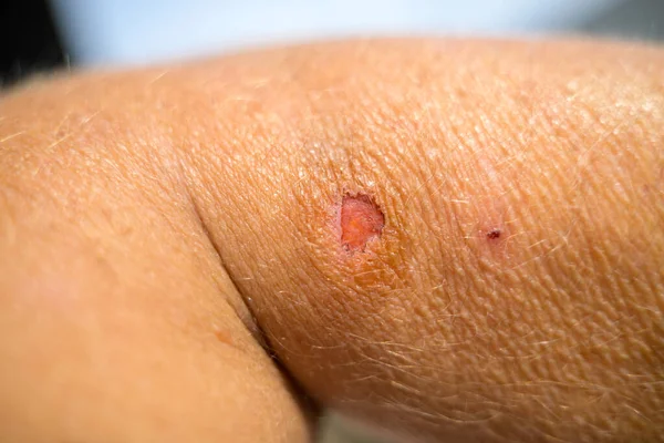 Detail of a healing soft tissue wound with surrounding trauma on a persons arm