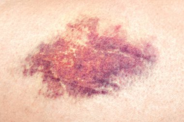 Bir kadının bacağındaki yaranın yakın plan görüntüsü..