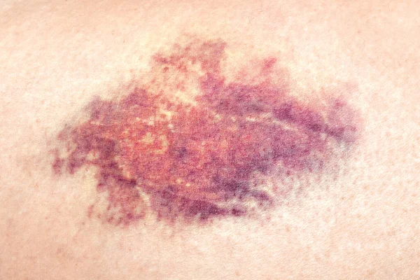 Close-up of a bruise on the wounded skin of a womans leg. — Stock Photo, Image