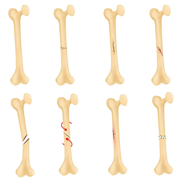 Fracture Broken Bone — Stockfoto