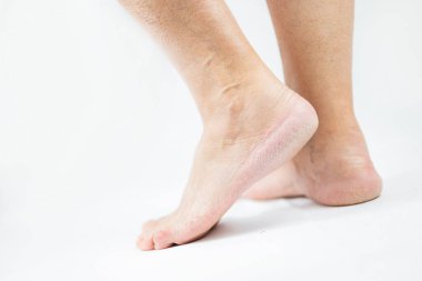 Yetişkin bir adamın ayakları kuru topuklularla yaşlanıyor ve beyaz arka planda çatlak bir hastalık var.