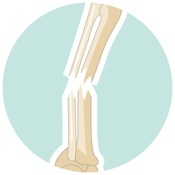 Human Broken Bone Cartoon Style Illustration — стоковый вектор