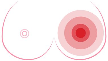 Meme Kanseri Bilinçlendirme konsept illüstrasyon