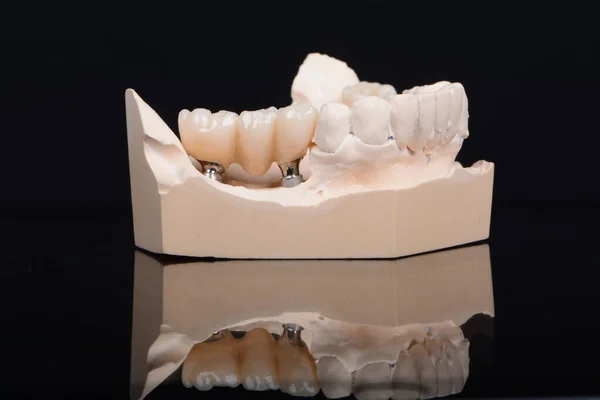 Tynk model dolnej szczęki z zębami cyrkonowymi na implantach. Proces produkcji zębów ceramicznych na implantach. — Zdjęcie stockowe
