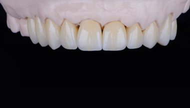 High-quality dental prosthesis made of zirconium single crowns for fixation to the upper jaw. Teeth treatment.