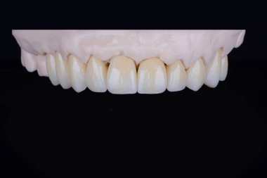 High-quality dental prosthesis made of zirconium single crowns for fixation to the upper jaw. Teeth treatment.