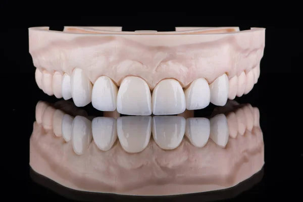 用锆单冠制成高质量的假牙 固定在上颚 并在黑色背景上反射 — 图库照片