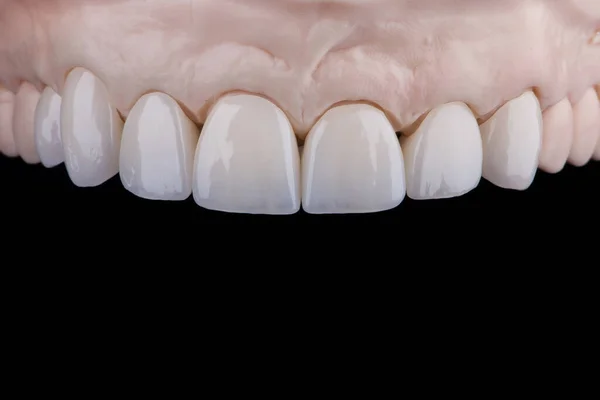 High Quality Dental Prosthesis Made Zirconium Single Crowns Fixation Upper — Stockfoto